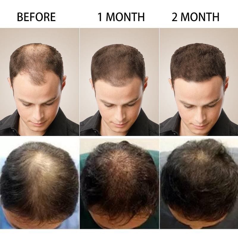Ginger Hair Growth Products Fast Growing Hair Essential Oil Natural Anti Hair Loss Prevent Hair Dry Frizzy Damaged Repair Care