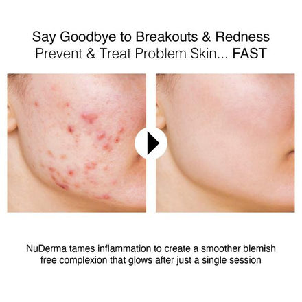 NuDerma Portable Skin Therapy Wand Machine Anti-Aging - Skin Tightening - Wrinkle Reducing