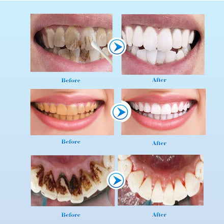 Teeth Whitening Serum Effective Remove Stains Plaque Deep Cleansing Dental Oral Hygiene Gel Teeth Whitening Kit Beauty Health