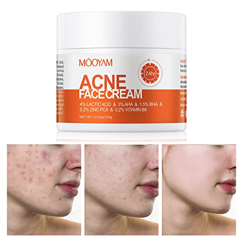 Acne Treatment for Face, Salicylic Acid Acne Cream Back Acne Treatment Cream