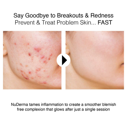 NuDerma Portable Skin Therapy Wand Machine Anti-Aging - Skin Tightening - Wrinkle Reducing